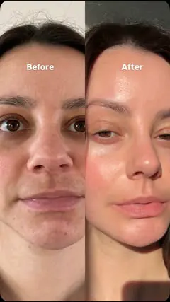 If you’re struggling with your skin ⬇️

Comment PRODUCTS and I’ll send you what I use ❤️ 

And yes, I do get chapped lips. 

1. Don’t buy every new product that promises clear skin, it will overload your skin. Staying consistent with three products (