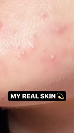 It’s easy to hide normal imperfections behind good lighting and angles, so this is your daily reminder most skin isn’t perfect 🙌🙌

This is my chin on a good day, full of white heads, red bumps, and inflammation. I have peach fuzz, hair on my upper 