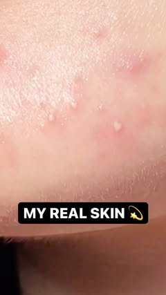 It’s easy to hide normal imperfections behind good lighting and angles, so this is your daily reminder most skin isn’t perfect 🙌🙌

This is my chin on a good day, full of white heads, red bumps, and inflammation. I have peach fuzz, hair on my upper 